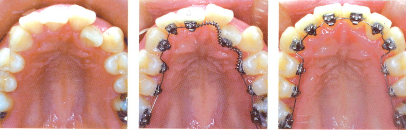 2007年10月02日●舌侧矫正(lingual orthodontics)~~兼论stb 矫正器